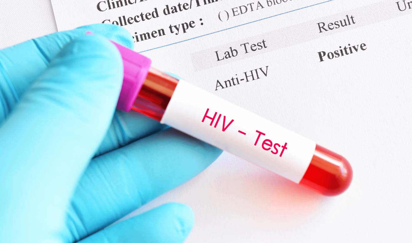 آزمایش hiv