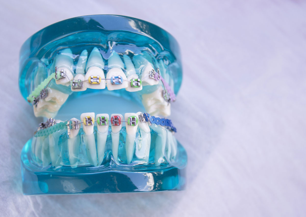 ترمیم و زیبایی دندان ها با ارتودنسی دندان