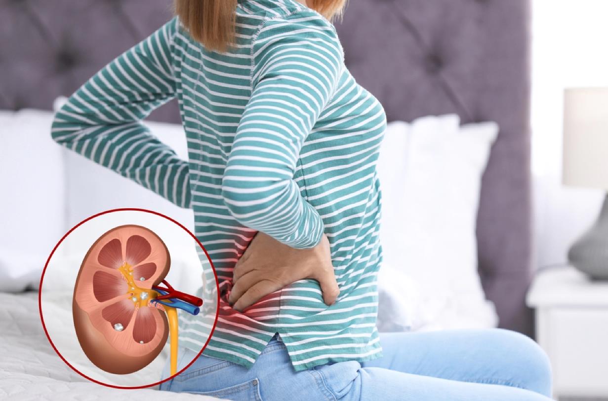 چگونه درد سنگ کلیه را آرام کنیم؟