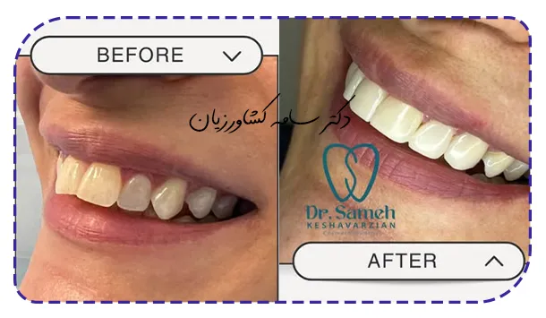 عکس قبل و بعد طراحی دیجیتال لبخند دندان