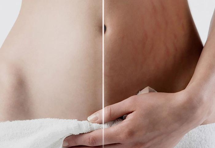 درمان ترک های پوستی در کلینیک میروژ