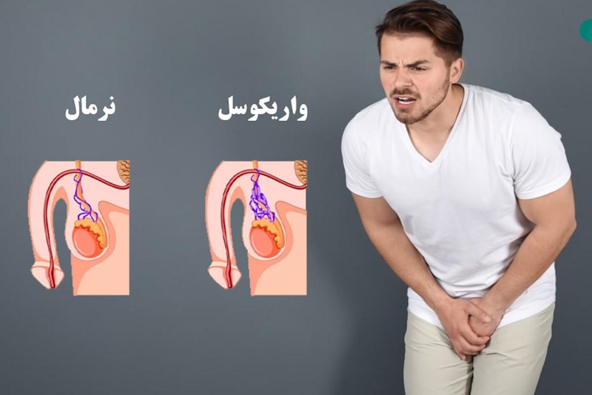 عوارض واریکوسل